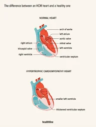 Obstructive HCM